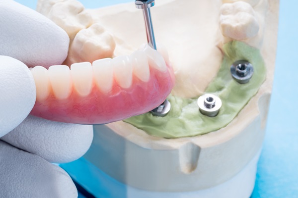 Comparing Implant Supported Dentures With Traditional Dentures